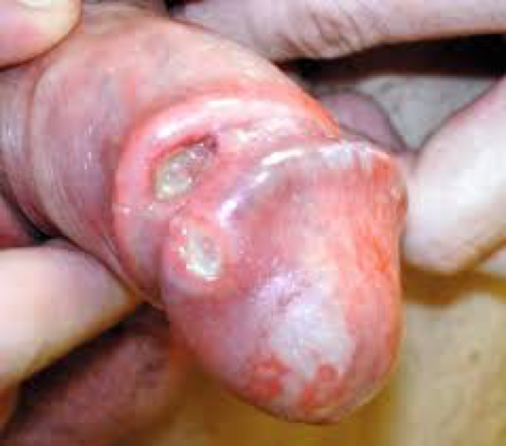 cancer of the penis Cancer of the penis